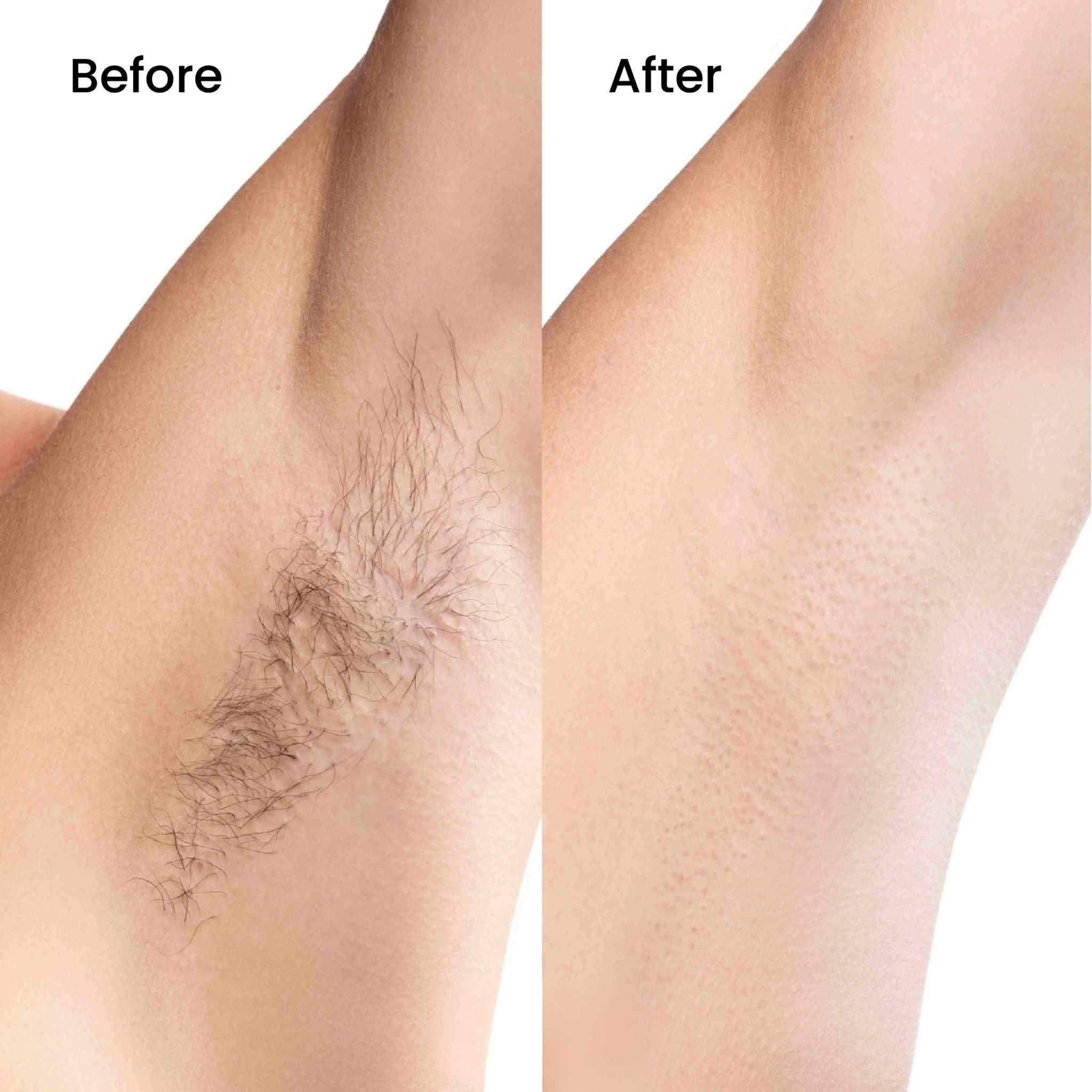 Bexola IPL Hair Removal