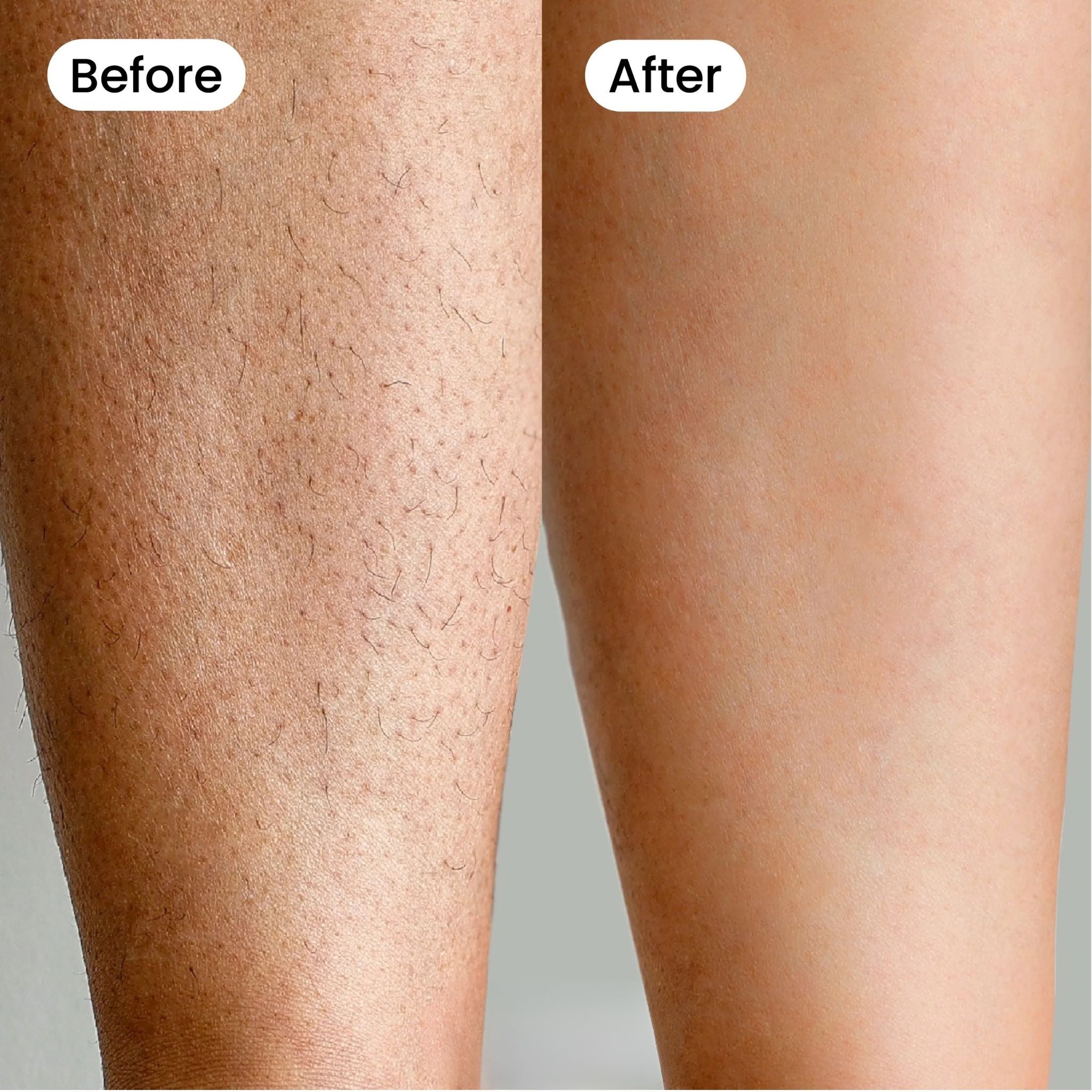 Bexola IPL Hair Removal