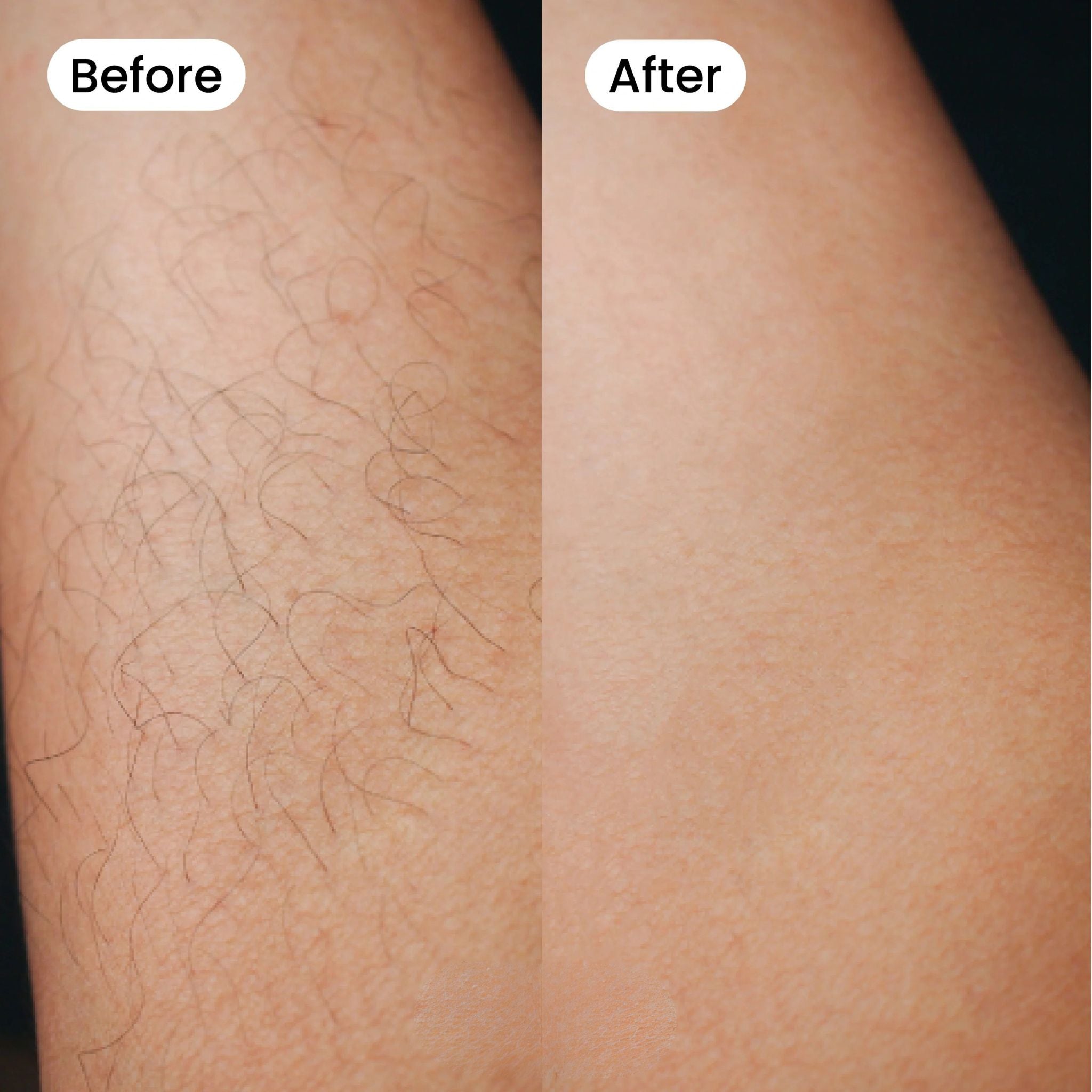 Bexola IPL Hair Removal