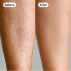 Bexola IPL Hair Removal