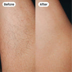 Bexola IPL Hair Removal