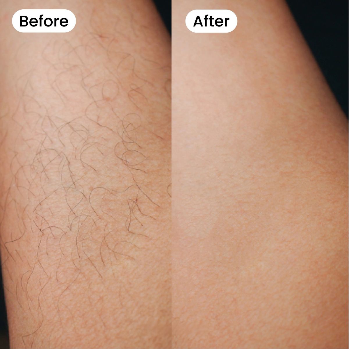 Bexola IPL Hair Removal